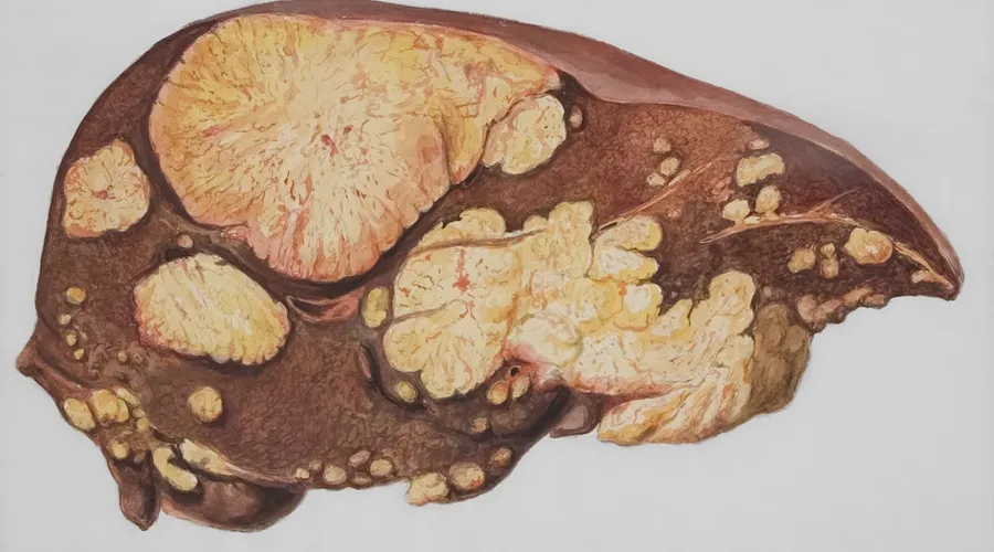 hepatitis b