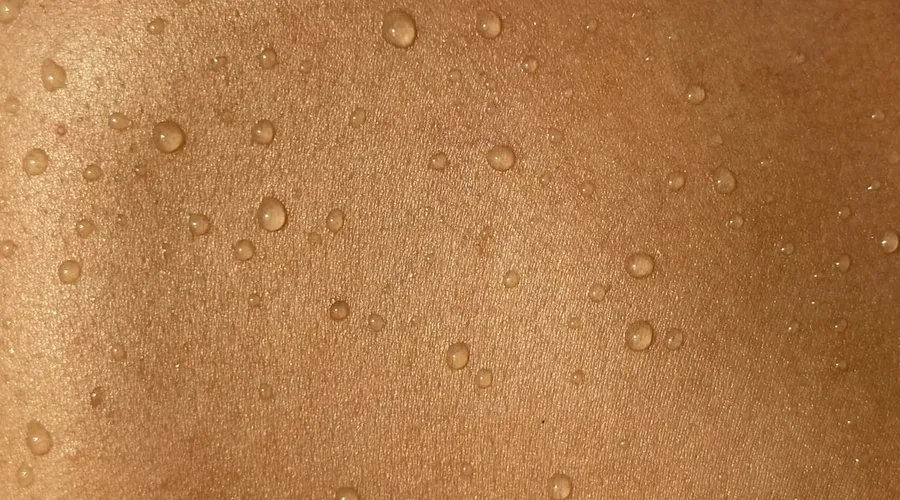 psoriasis