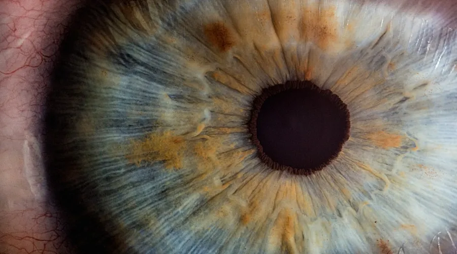 retinitis pigmentosa