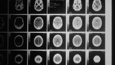 SORLA-Protein blockiert beide Alzheimer-Pathologien in Mäusen